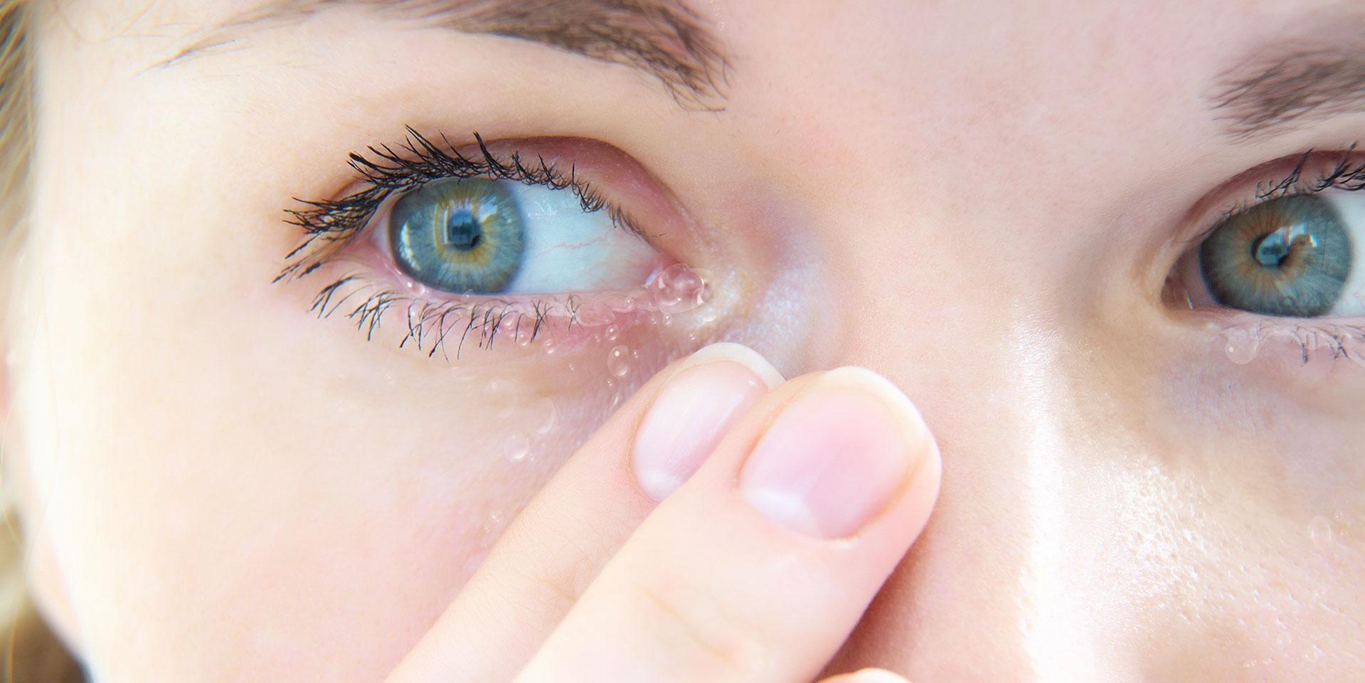 Problema de salud: ojos llorosos