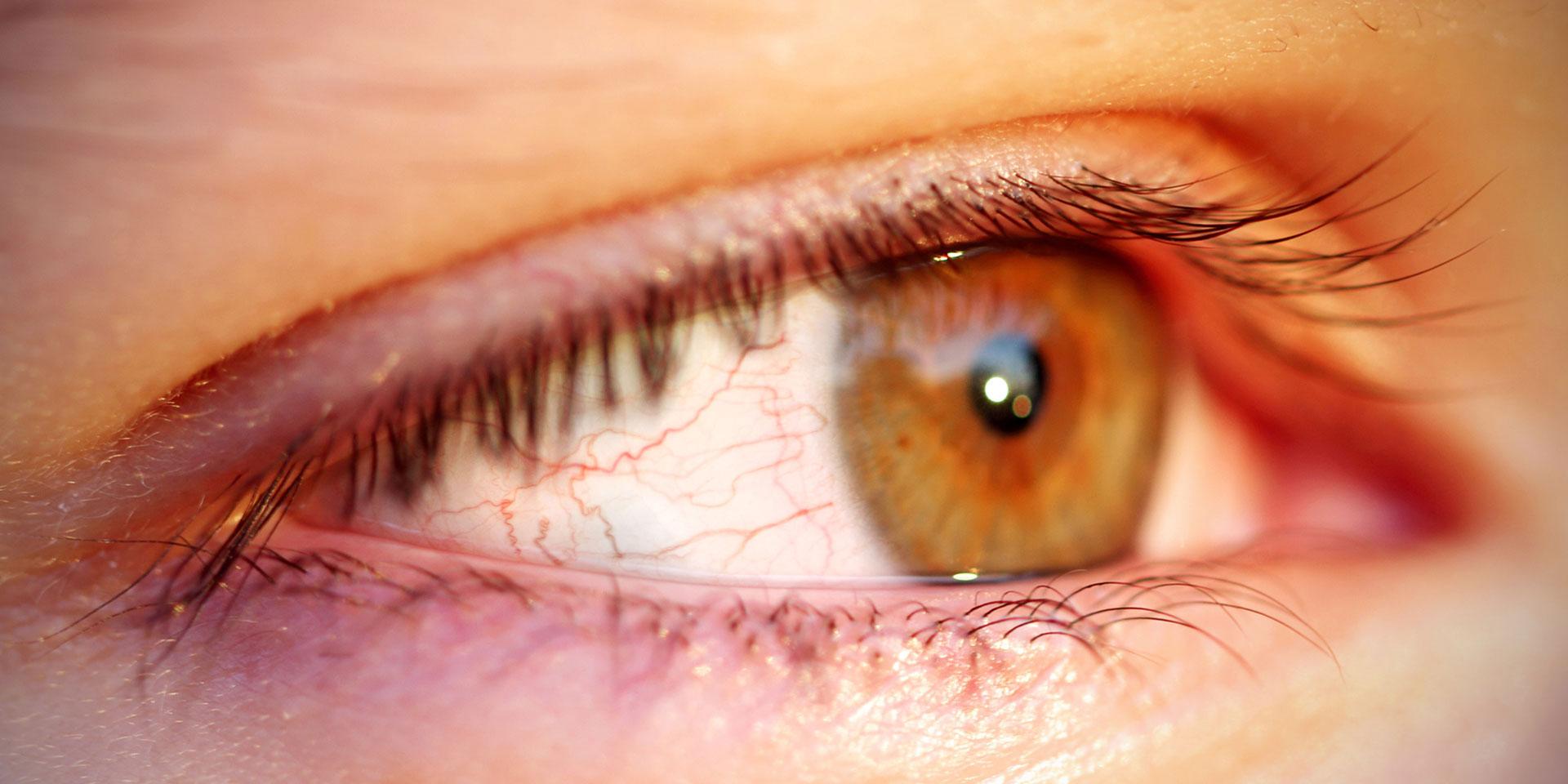 Ojos rojos o irritados