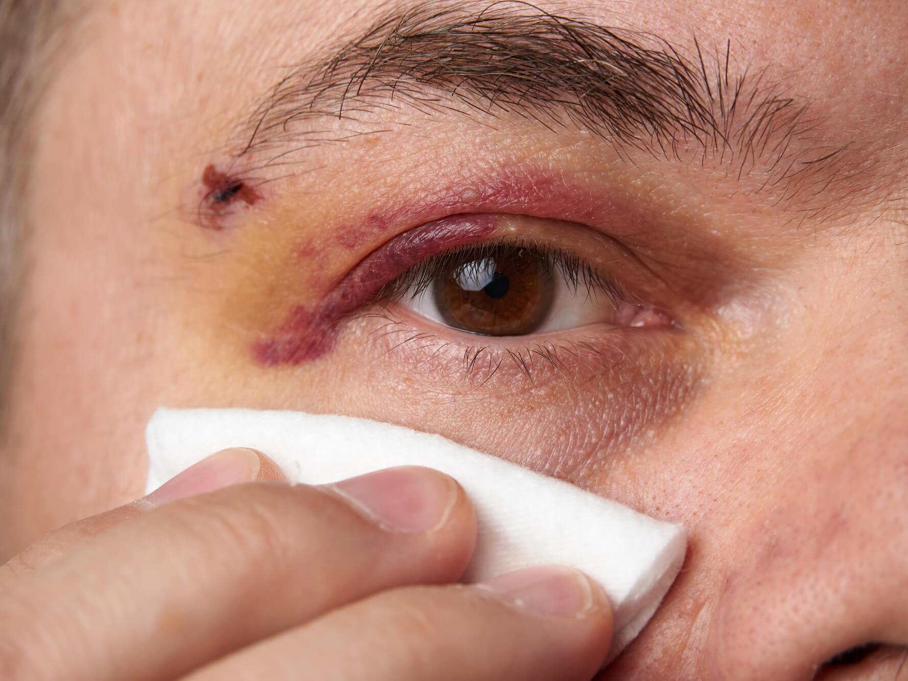 Aplicar una compresa fría en la zona de los ojos poco después de una lesión puede reducir la hinchazón y aliviar el dolor.