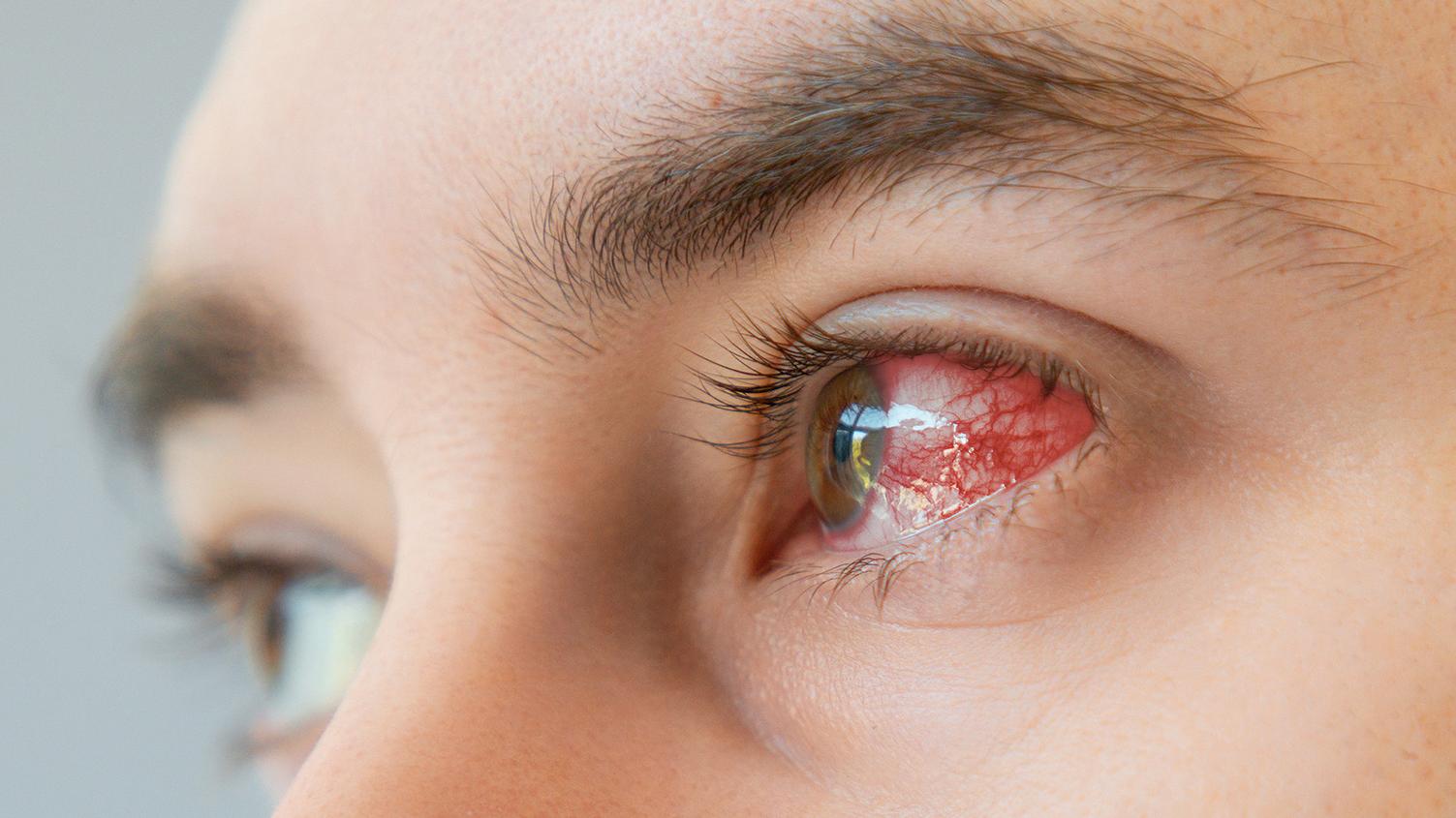 Daño corneal