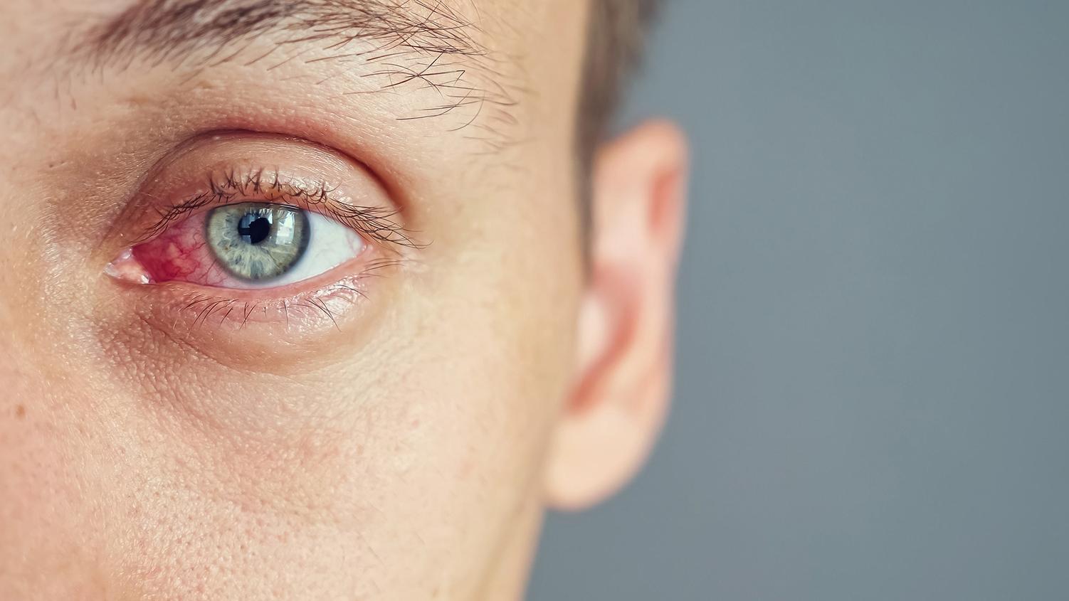 Inflamación ocular