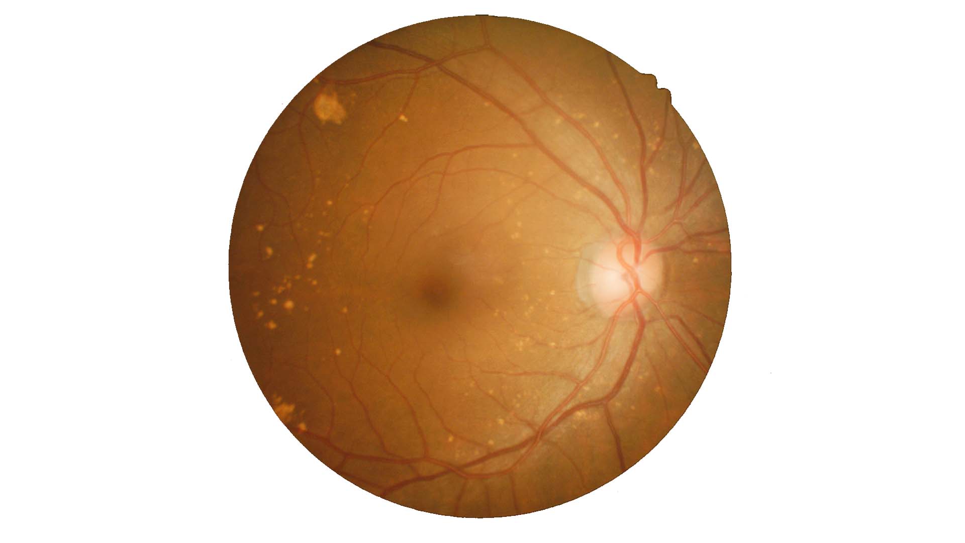 Daño retinal